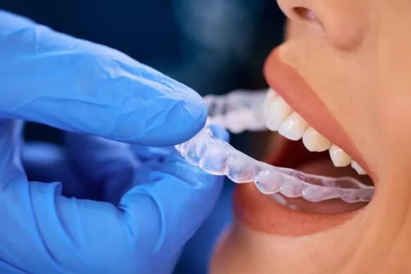 Get-a-Beautifully-Aligned-Smile-with-Invisalign-1080x675