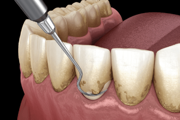 Scaling-and-Root-Planing-1-768x493